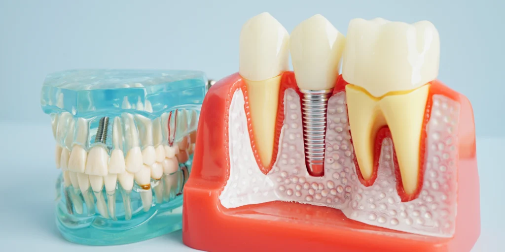 implant dentaire Implants dentaires Dr Johan Cinçon - Chirurgien-dentiste à La Teste-de-Buch